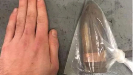 بريطاني يهرع إلى المستشفى لسحب قذيفة من الحرب العالمية الثانية علقت في شرجه