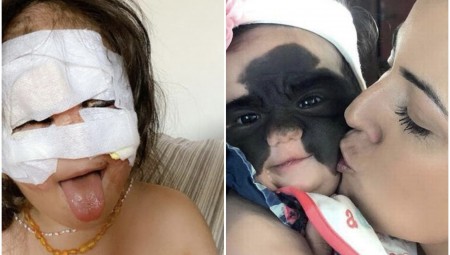 في عملية نادرة.. طبيب روسي يخلص طفلة أميركية من وحمة  باتمان