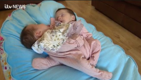 زوجان بريطانيان يرزقان بتوأم ملتصق وينتظران إجراء عملية جراحية دقيقة لهما