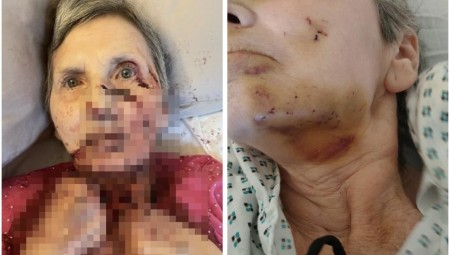 بريطانيا.. جرذ كبير يهاجم مسنة ويحاول قضم وجهها ورقبتها أثناء نومها