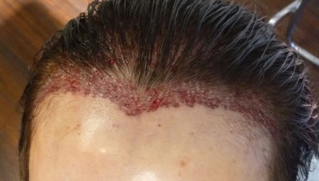 في الهند... عملية زرع الشعر قد تكون قاتلة